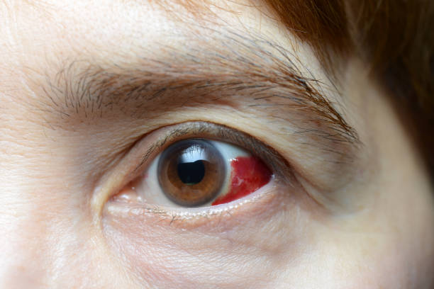 Burst blood vessel in eye